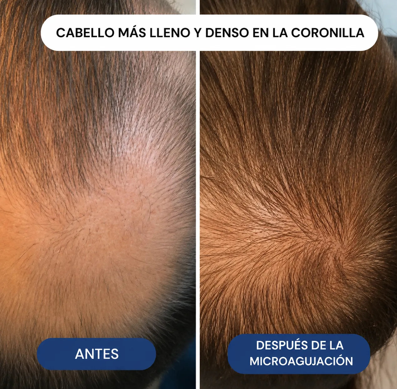 El Sistema de Regeneración Capilar con Infusión de Péptidos Más Potente